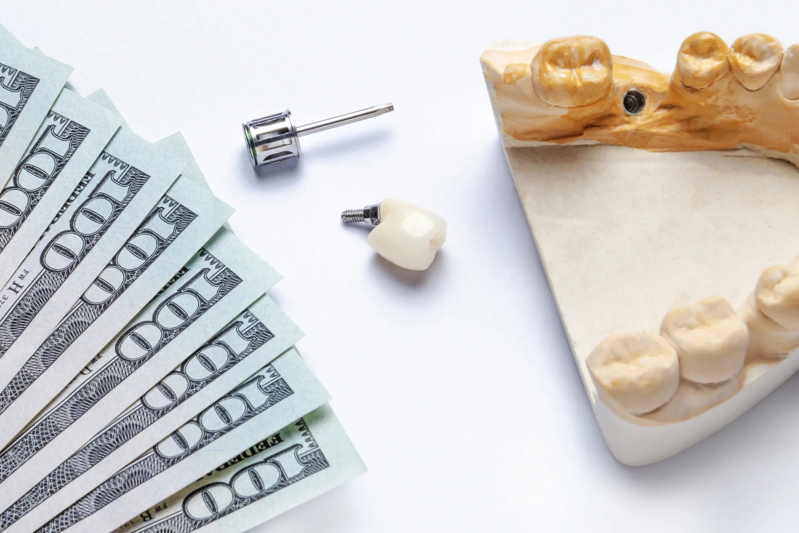 How Much Do Dental Implants Cost in Riverview, FL? (2026 Guide)